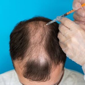 PRP Hair Restoration Deposit
